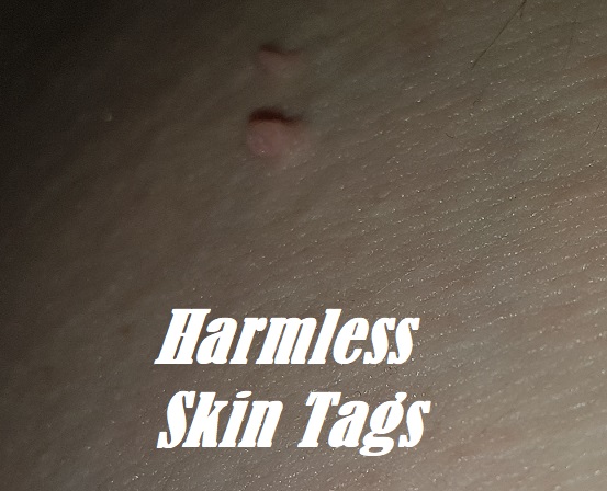Does Being Overweight Cause Skin Tags